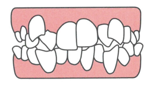 歯並びが悪くなる原因とは？