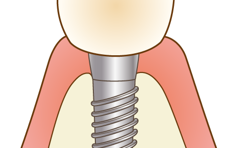 インプラントのメインテナンス　定期的に受けていますか？